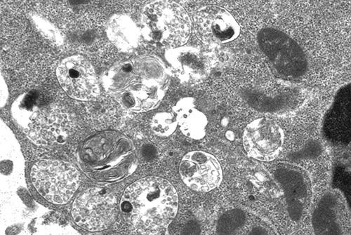Mucolipidosis B Cell