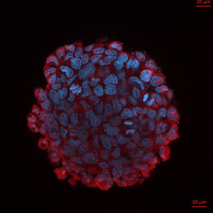 3D Tumor Spheroid Model Showing Medulloblastoma Stem Cells
