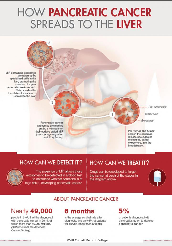 Pancreatic Cancer Spreading to the Liver