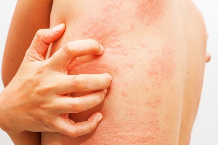 Increased Depression, Suicidal Thoughts and Stress Reported in Patients with Chronically Itchy Skin