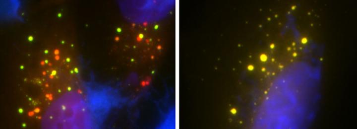 UBQLN2 Gene Variations Determine Important Cell Recycling Process