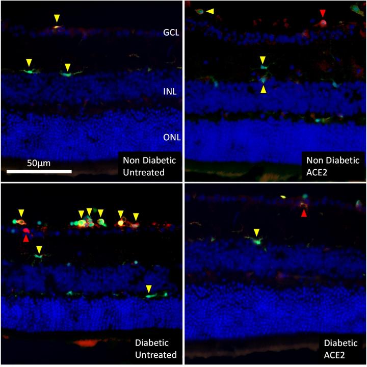 Intraocular Therapy Prevents or Reverses Diabetic Retinopathy in Mice