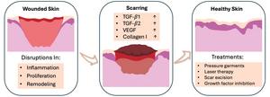 Disruptions during wound healing phases (inflammation, proliferation, and remodeling) can result in scar formation. Higher levels of inflammatory markers (TGF-β1, TGF- β2, VEGF) and type 1 collagen are present in scars. Current treatments for scars incl