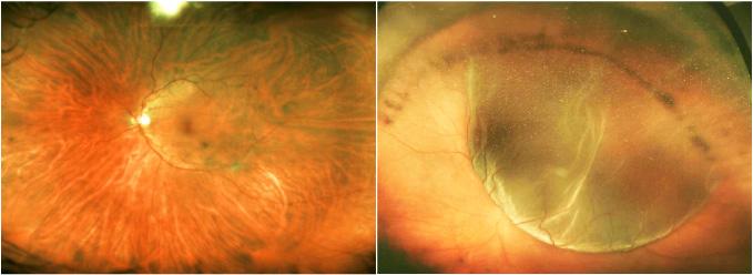 Human Normal vs. RD Retinal Fundus