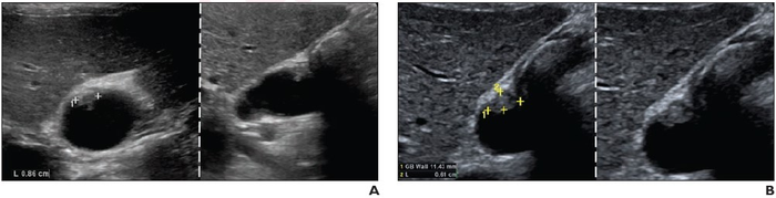 60-Year-Old Woman With Chronic Hepatitis B