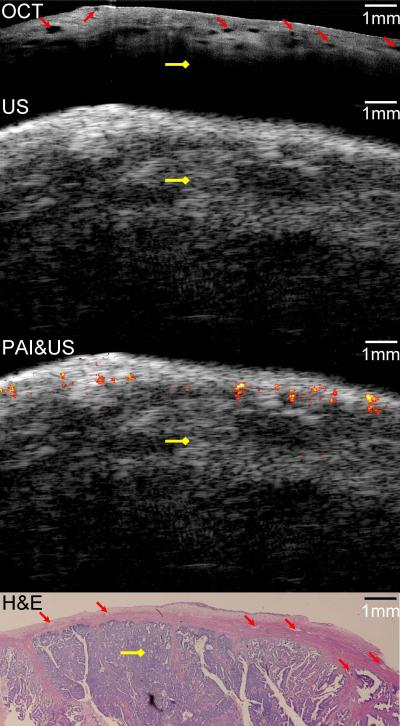 Malignant Ovarian Tissue