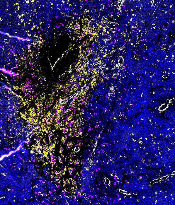 Accumulation of different types of immune cells in a bone marrow lesion with breakout myeloma cells