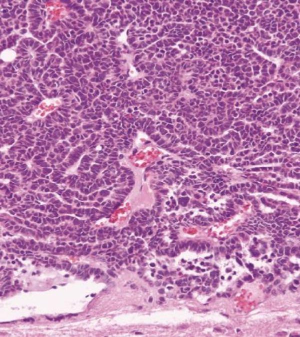 Choroid Plexus Carcinoma