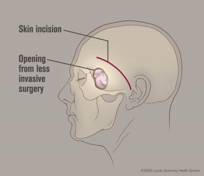 Less Invasive Brain Surgery