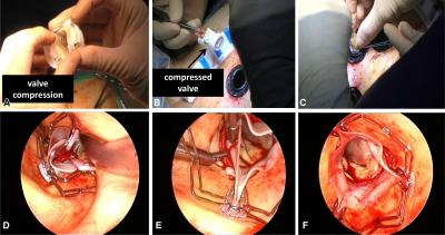 First Human Totally Endoscopic Aortic Valve Replacements (TEAVR) Reported