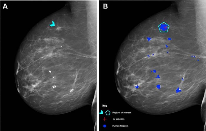 Mammogram shows an 8-mm ill-defined mass