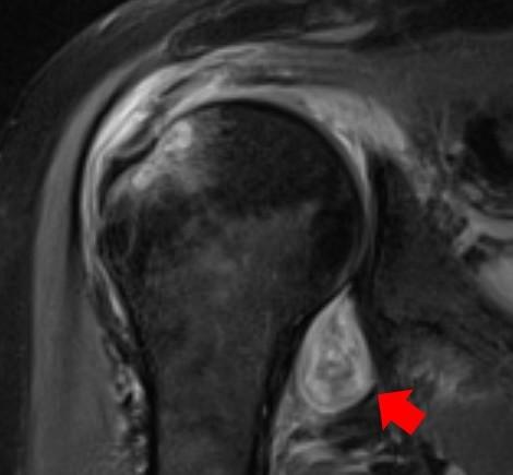MRI of shoulder post-COVID