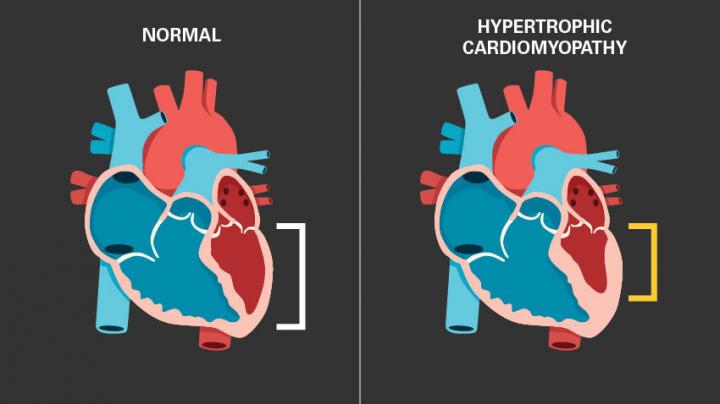 A change of heart - New drug for HCM reduces heart mass