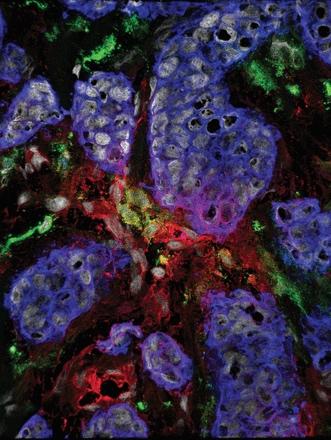 Human Breast Cancer Tissue Stained by Immunofluorescence