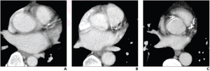 (A) mild, (B) moderate, (C) severe CAC on non-gated contrast-enhanced chest CT