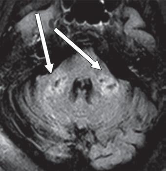 78 YO woman with hypertension and stage IV chronic kidney disease, presenting with COVID-19 and altered mental status