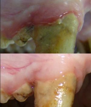 Untreated and Treated Tooth
