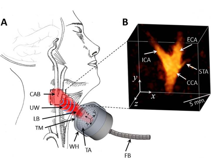 Novel Technique Accurately Assesses Cardiovascular Risks