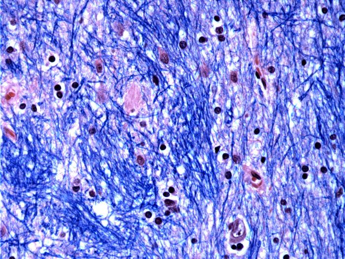 Histological staining of the caudate nucleus from a person with Huntington's disease