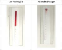 Example of Fibrinogen Diagnostic Tool