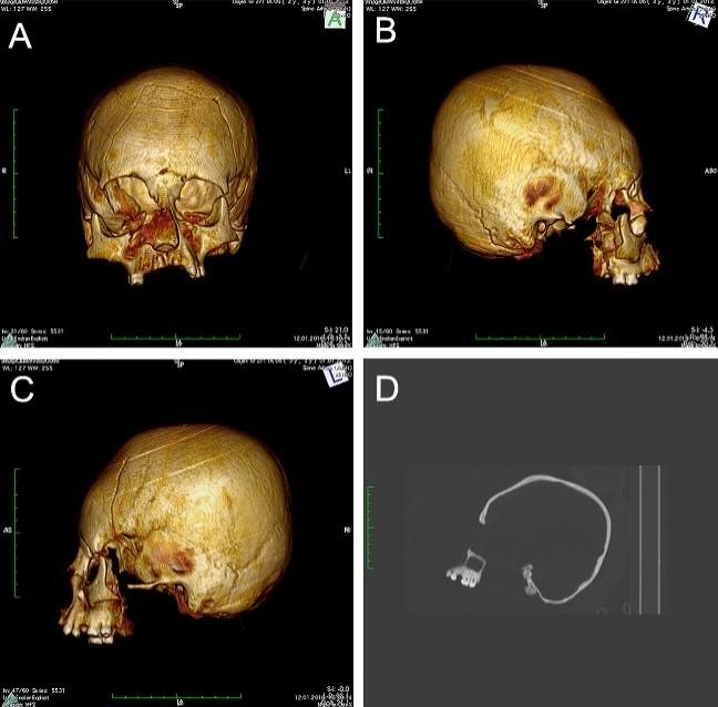 Earliest Evidence of Artificial Cranial Deformation in Croatia during 5th-6th Century