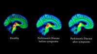 Progression of Parkinson's Disease in Brain (Black Background)