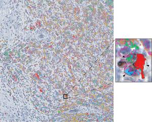 Immune Cell Interactions in Tumors