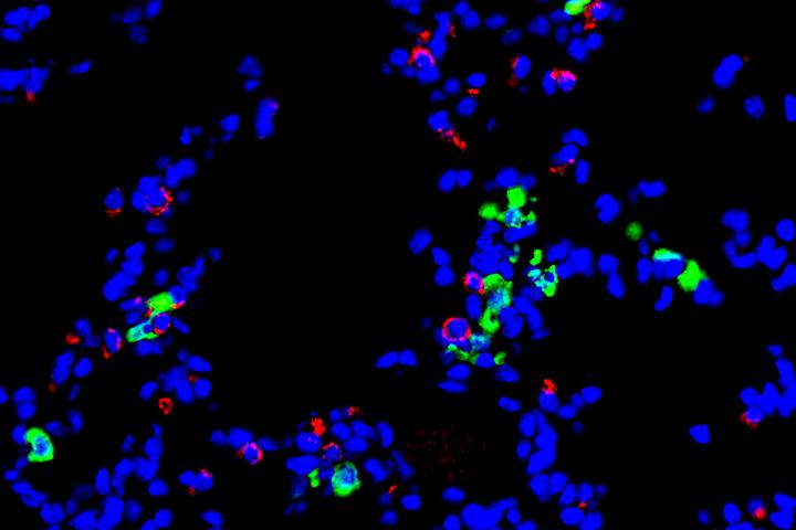 Immune cell implicated in development of lung disease following viral infection