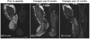 Alpelisib improves the symptoms of infant PROS patients