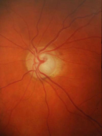 Primary Open Angle Glaucoma