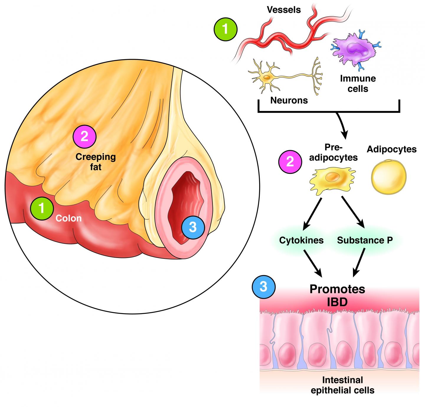 The Role of Intra-Abdominal Fat in IBD Uncovered