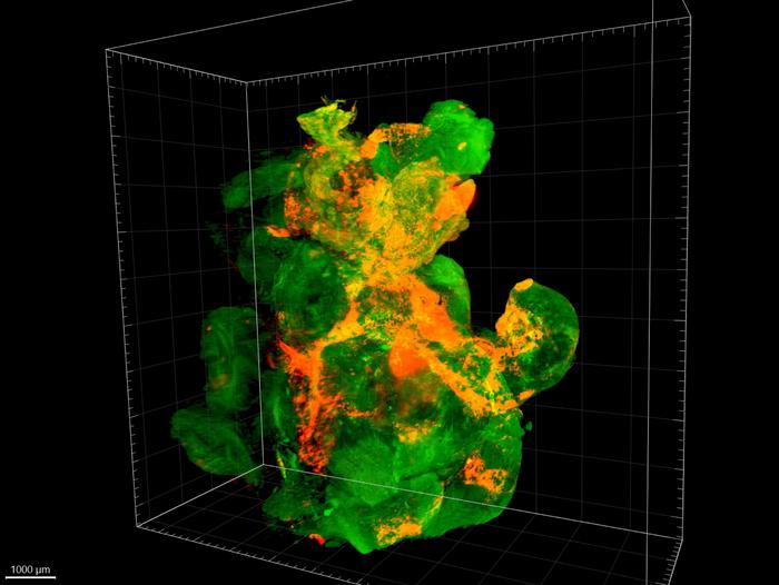 A tumor under the fluorescence microscope: the tissue of this pancreatic tumor in a mouse glows green, the nanoparticles orange. (Copyright: Myrto Ischyropoulou / Max Planck Institute for Multidisciplinary Sciences)