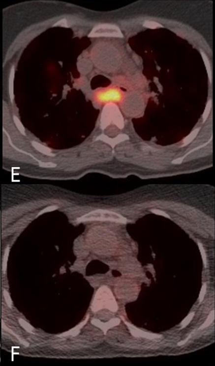 Upper Chest Pre and 3 months' Post Treatment
