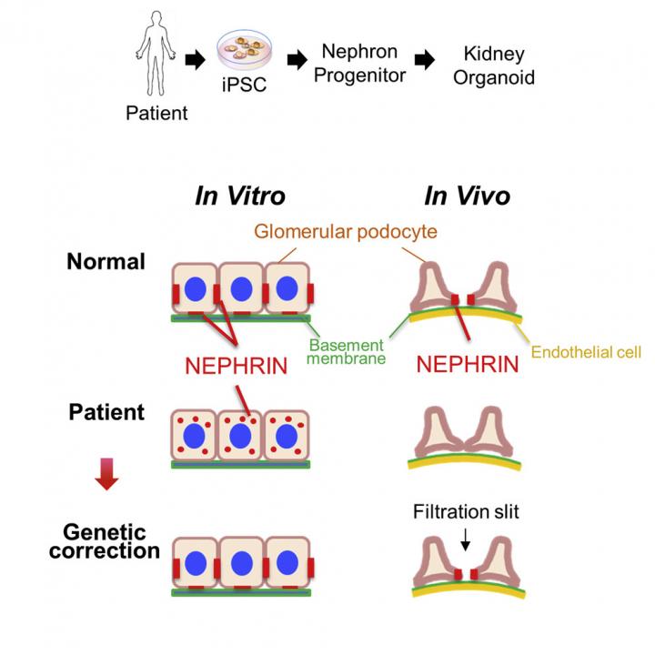 Abnormal Podocytes Generated from Patient-derived iPS Cells