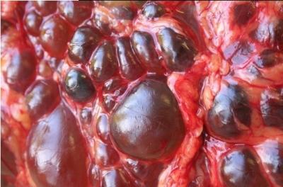 Polycystic Kidney Disease 2