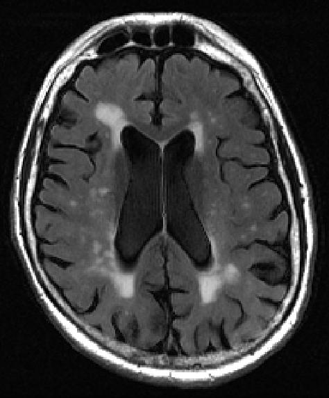 MRI image of human brain