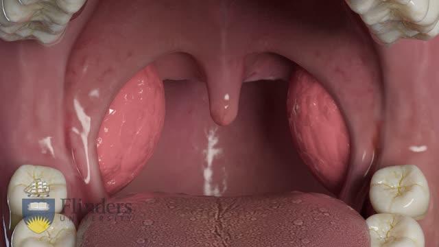 Tonsillotomy animation