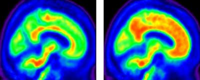 Brain Scans of Healthy Adults Showing Low and High Levels of Beta-amyloid Protein