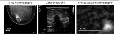 Diagnostic Images of a Mixed Infiltrating Lobular and Ductal Carcinoma