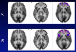 18F-FDG scans in subject with mild cognitive impairment and untreated hearing loss.