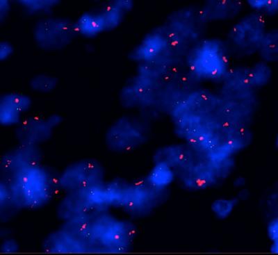 Squashing Cancer in Smoker's Lungs (3 of 3)