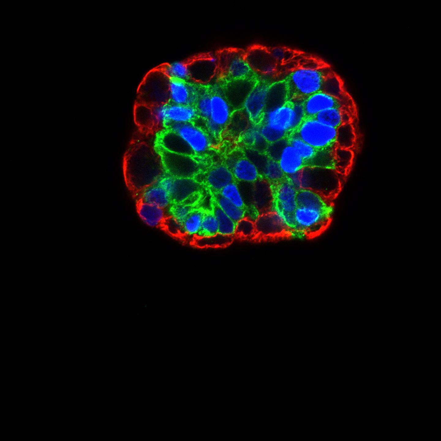 Metastasis and Drug Resistance in Cancerous Cells