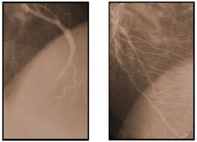 Healthy Angiogenic Response after Generx® Treatment
