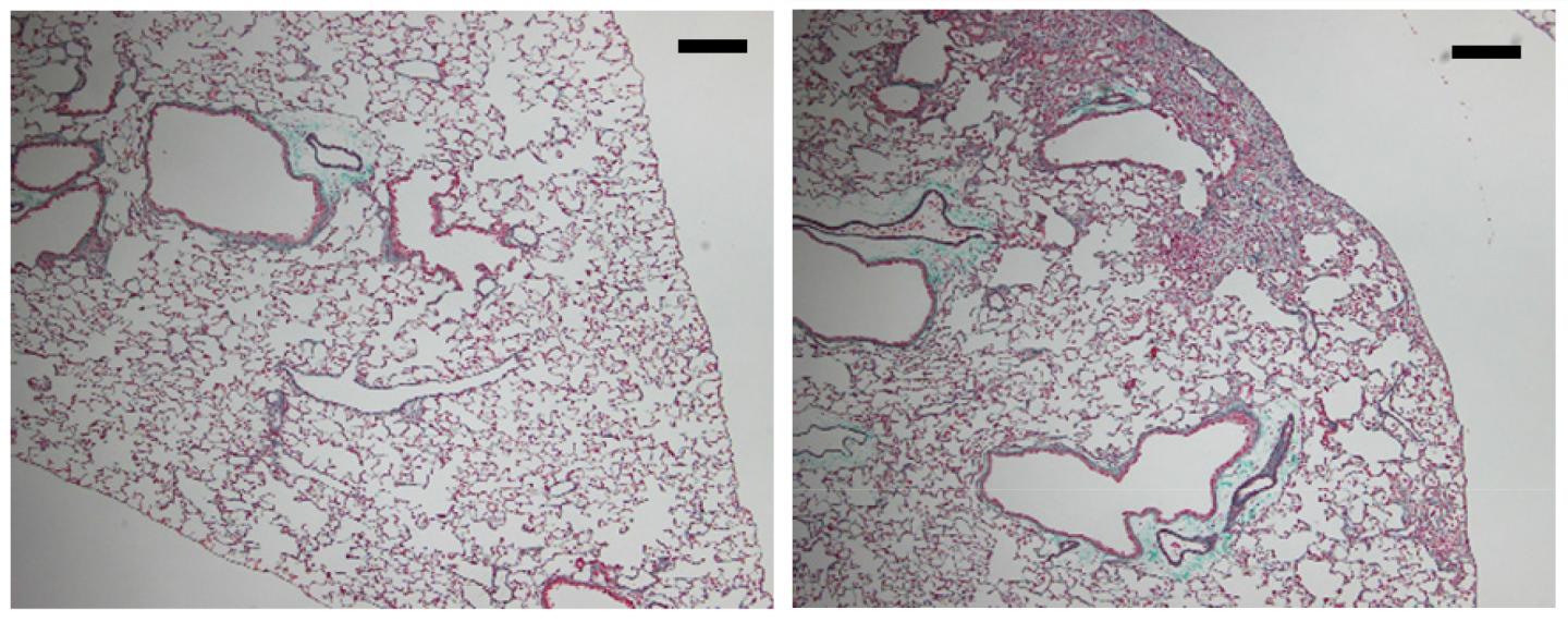 A Mutation In <I>SFTPA1</i> Causes Idiopathic Pulmonary Fibrosis