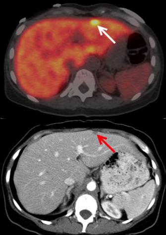 49-Year-Old Female with Metastatic Pancreatic