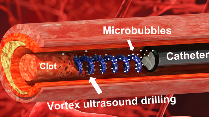 Ultrasound ‘Tornado’ Breaks Down Blood Clots