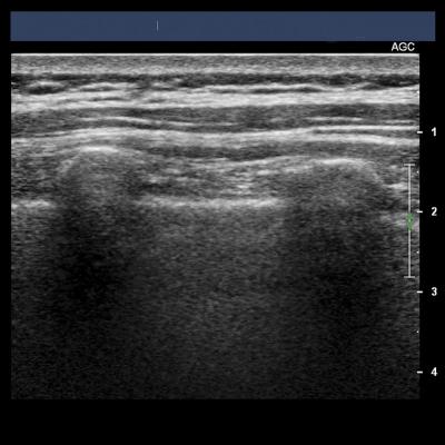 Lung Ultrasound