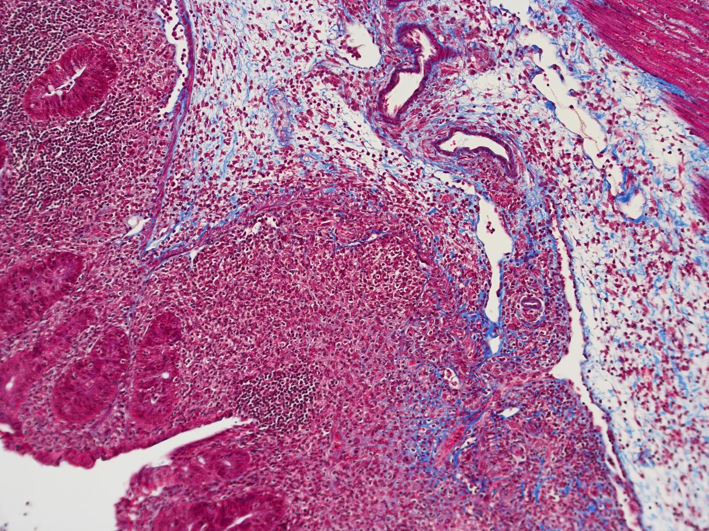 On the Road to Therapy for Crohn's-Related Fibrosis (6 of 9)