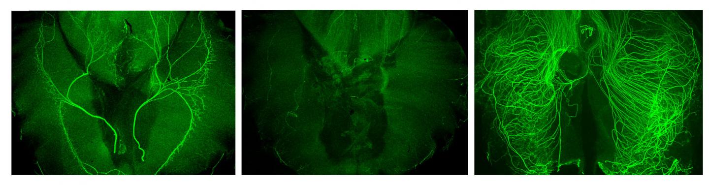 Nerves Affected By Degeneration