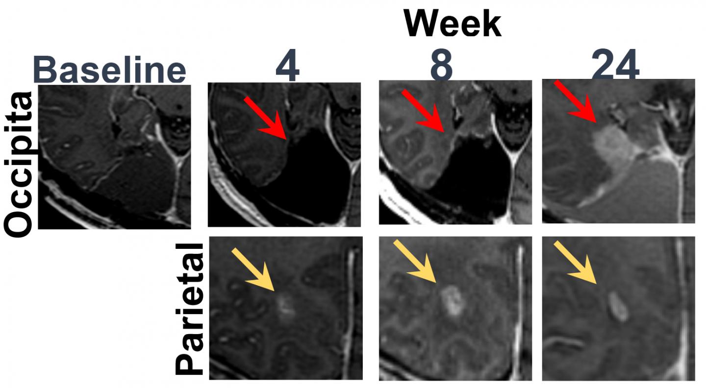 Two-Pronged Gene Therapy for Glioblastoma Proves Safe in Phase 1 Trial (1 of 3)